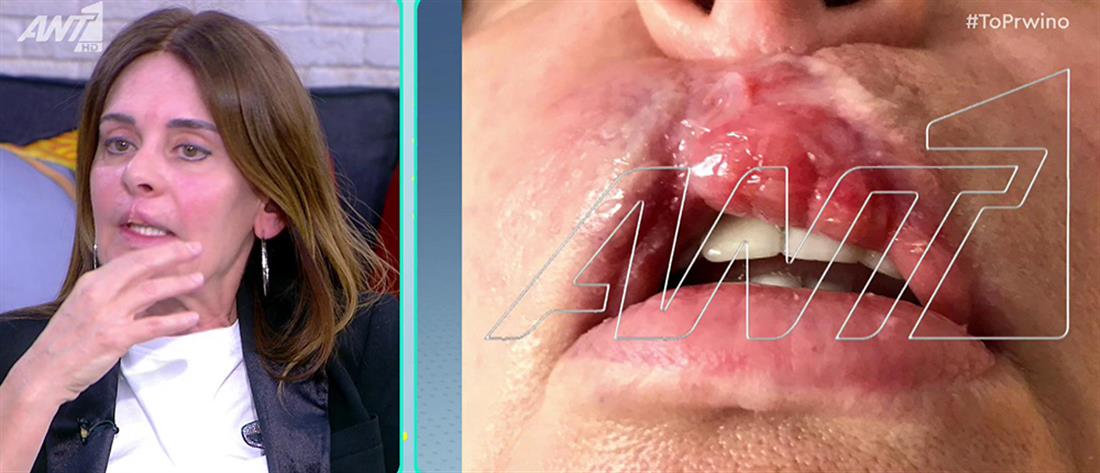 “To Πρωινό” - Κατερίνα Πλουμιδάκη: Τα χείλη μου “σάπισαν” μετά από πλαστική επέμβαση (βίντεο)