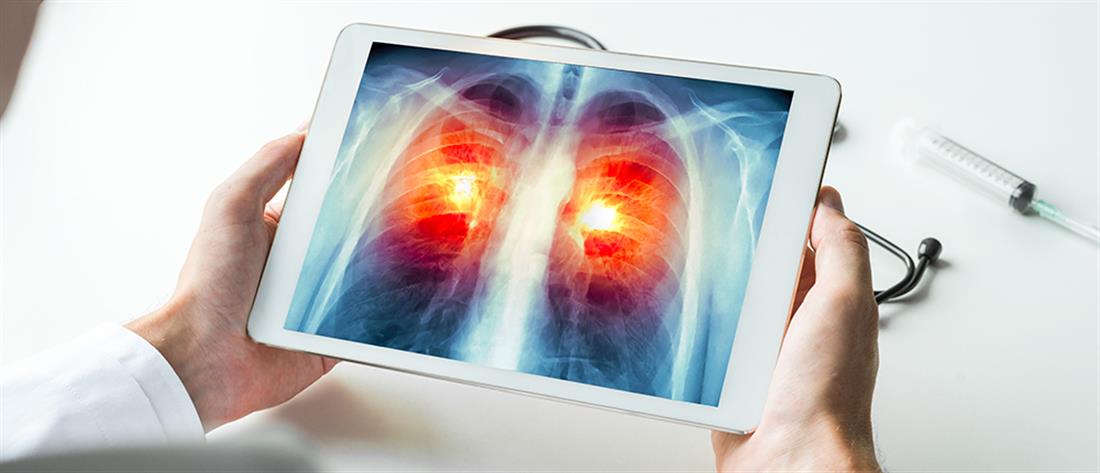 Καρκίνος του πνεύμονα: “Μοριακό μονοπάτι” γεννά ελπίδες για την αντιμετώπιση του