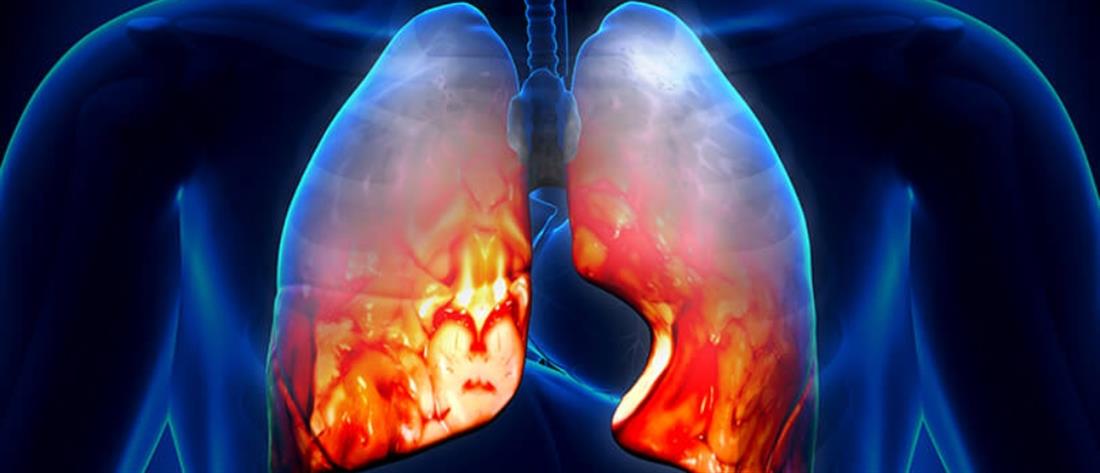  Οι λοιμώξεις του αναπνευστικού συστήματος