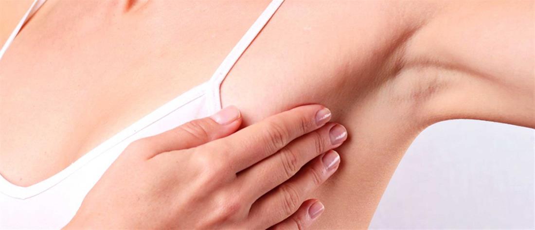 Cryoablation: Νέα μέθοδος αντιμετώπισης όγκων μαστού χωρίς χειρουργείο