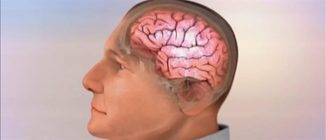 ADUCANUMAB: H πρώτη αιτιολογική θεραπεία για τη νόσο Alzheimer