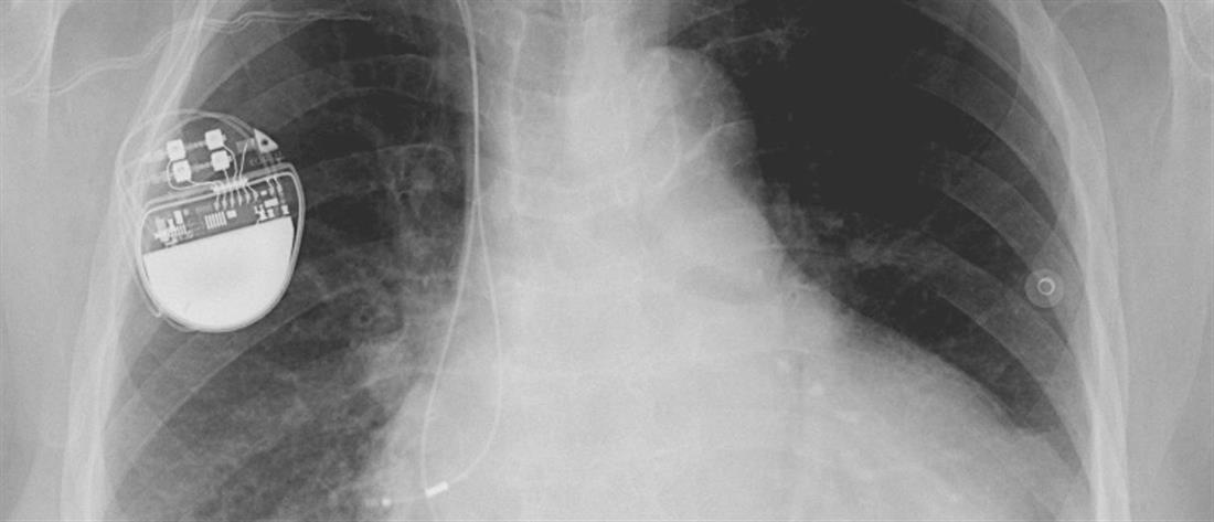 Βηματοδότης χωρίς ηλεκτρόδια (leadless pacemaker): Μικρότερο μέγεθος, μεγαλύτερη ευελιξία