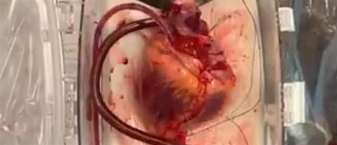 Έκαναν μεταμόσχευση καρδιάς από νεκρό δότη (βίντεο)